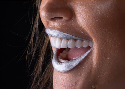 LENTE DE CONTATO DENTAL - Porto Alegre, RS